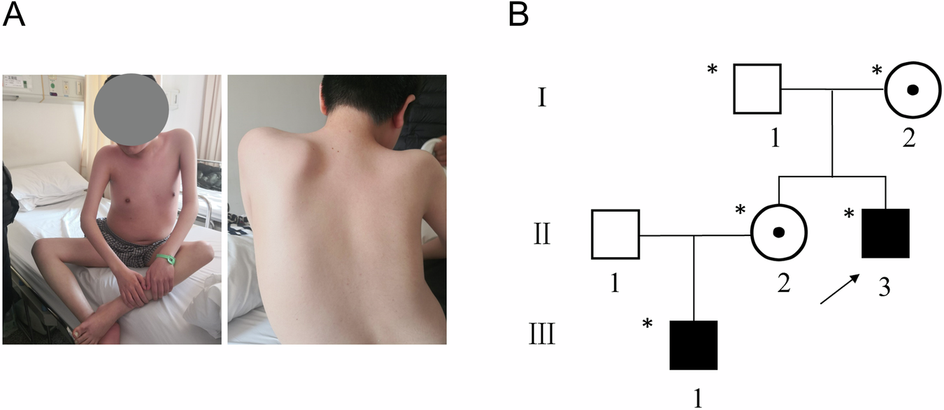 Pseudoexon activating by a deep intronic variant and phenotype variation in  a Chinese family with dystrophinopathy | Journal of Human Genetics