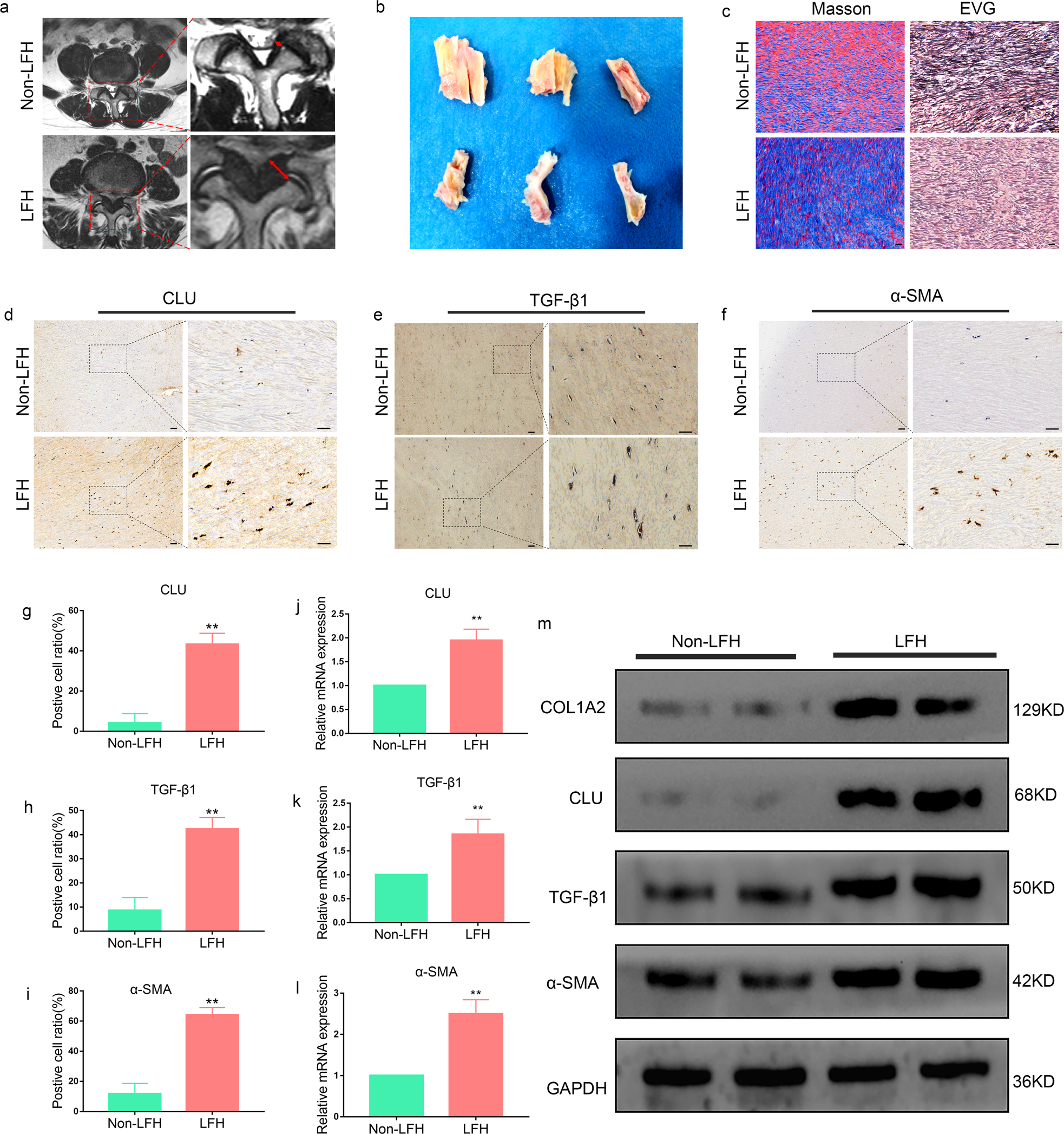 Fig. 2: CLU and fibrosis-related expression are upregulated in LFH.