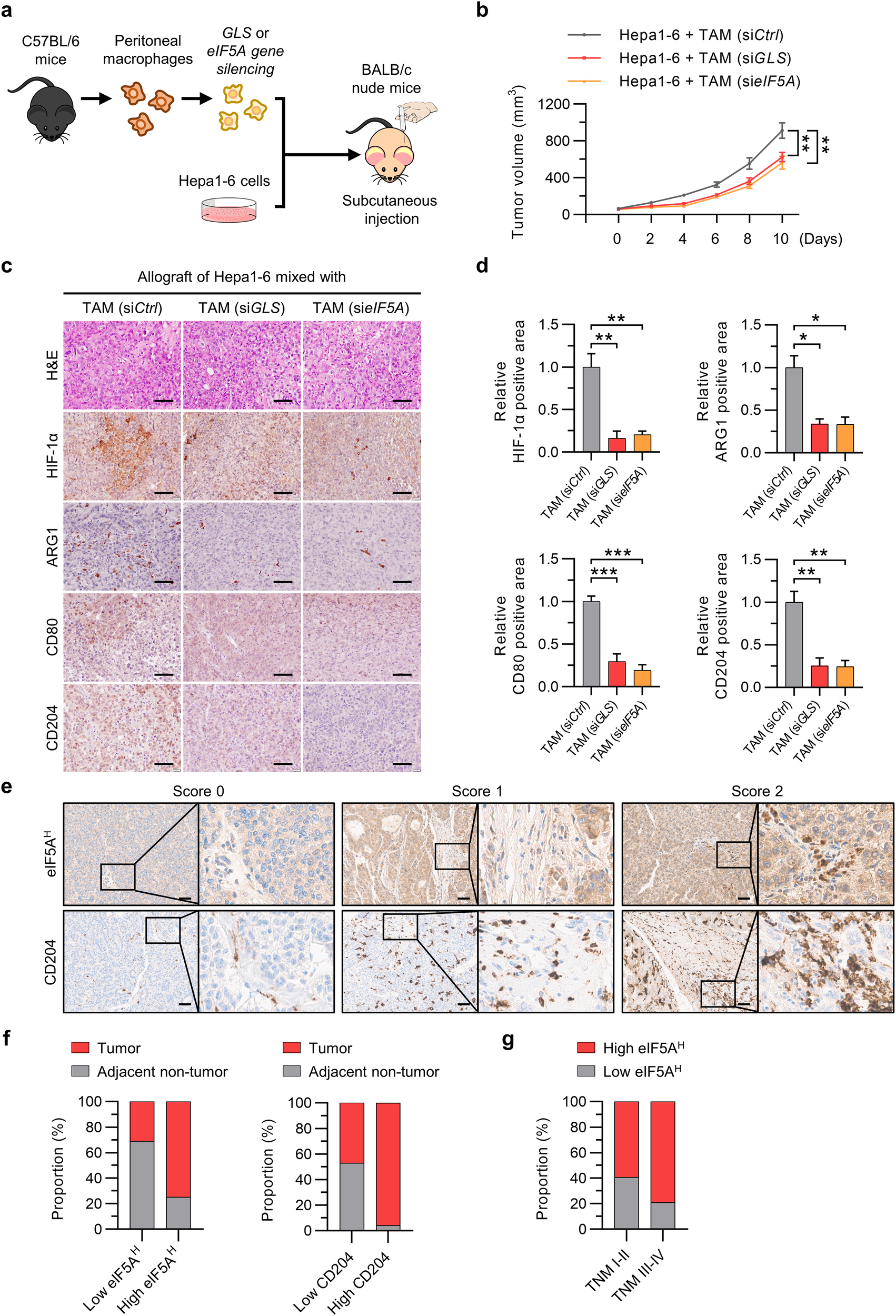 Fig. 6: Inhibition of eIF5A hypusination suppresses HCC tumor growth, and high levels of eIF5A hypusination in tumor stromal lesions are associated with advanced stage in patients with HCC.