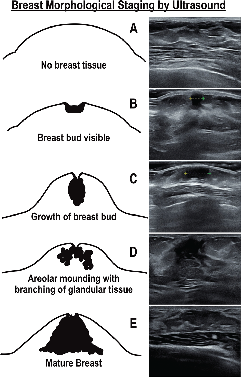 budding breast puberty  