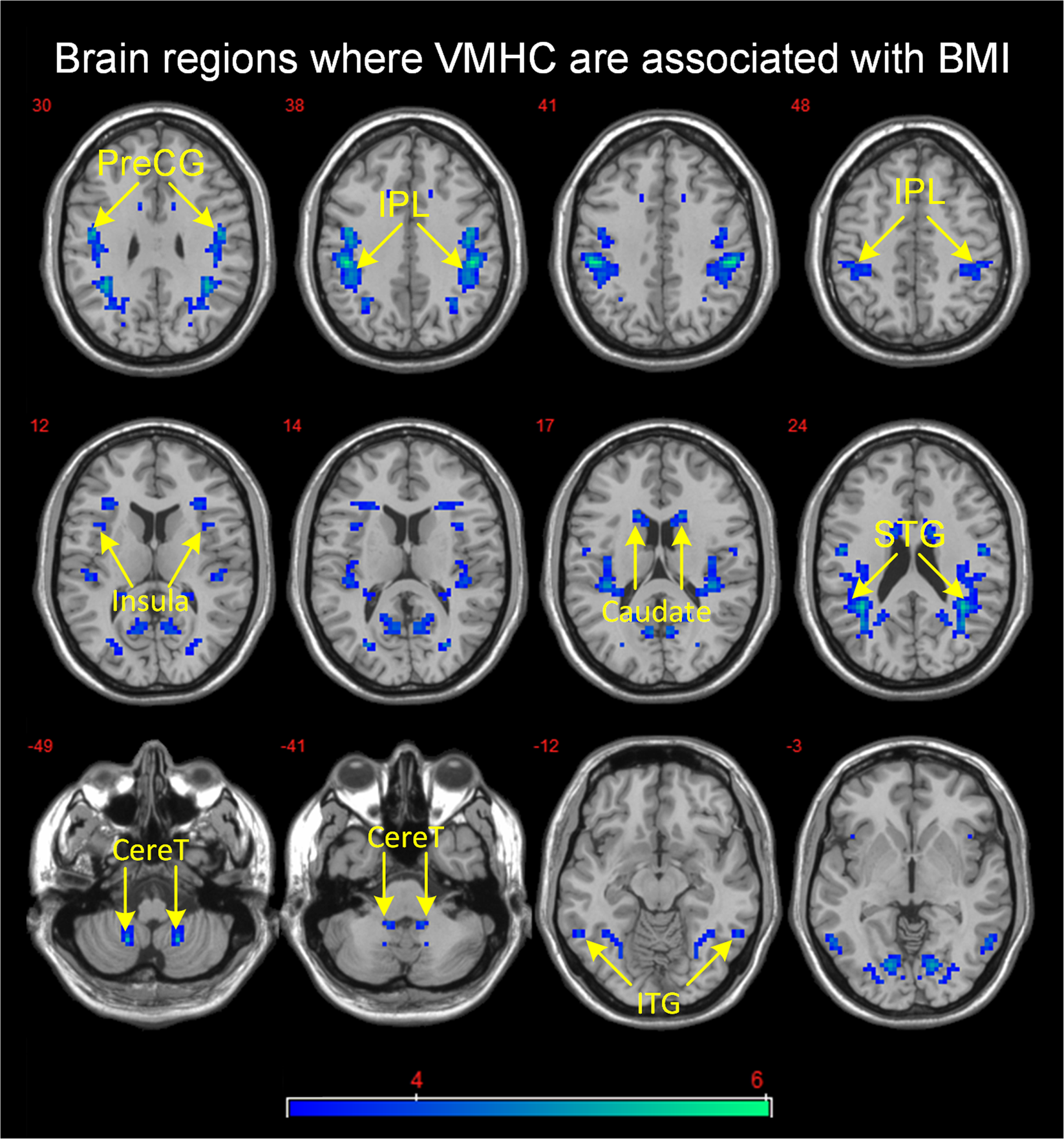 Contrasting dorsal caudate functional connectivity patterns between frontal  and temporal cortex with BMI increase: link to cognitive flexibility |  International Journal of Obesity