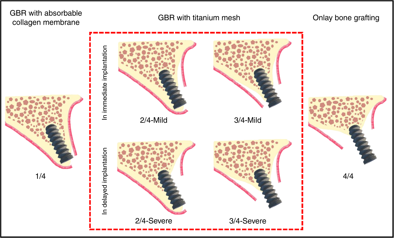 Titanium mesh for bone augmentation in oral implantology: current