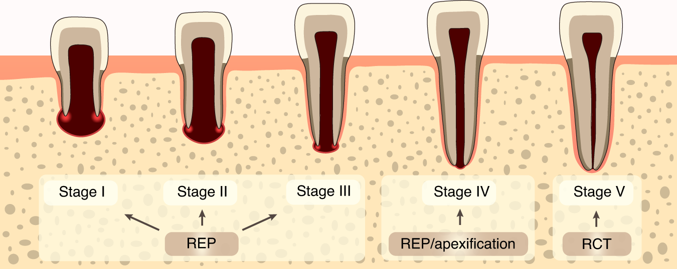 Representative images of a (A) 3-mm and (B) 6-mm apical plug and