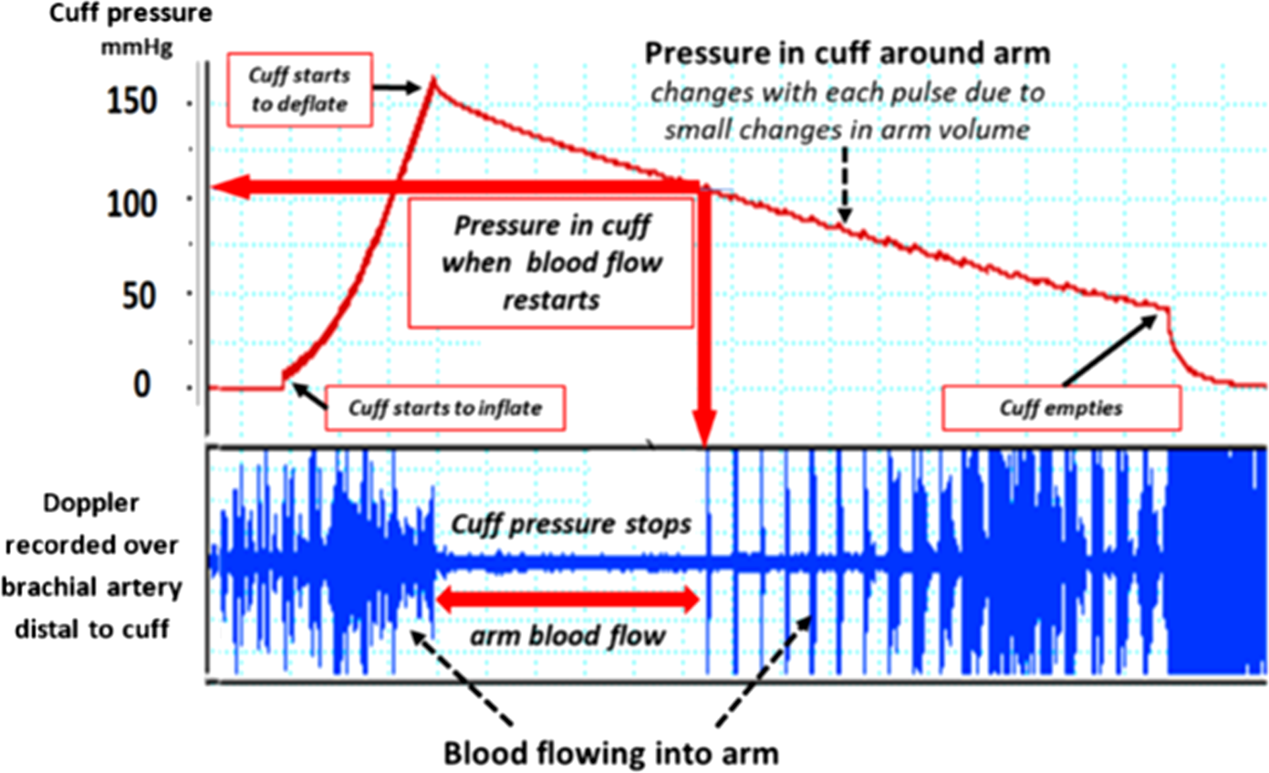 Oscillometric measurement of blood pressure: a simplified explanation. A  technical note on behalf of the British and Irish Hypertension Society |  Journal of Human Hypertension