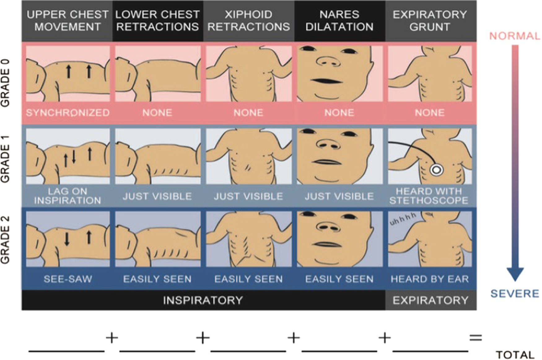 Performance of the Silverman Andersen Respiratory Severity Score in  predicting PCO2 and respiratory support in newborns: a prospective cohort  study | Journal of Perinatology