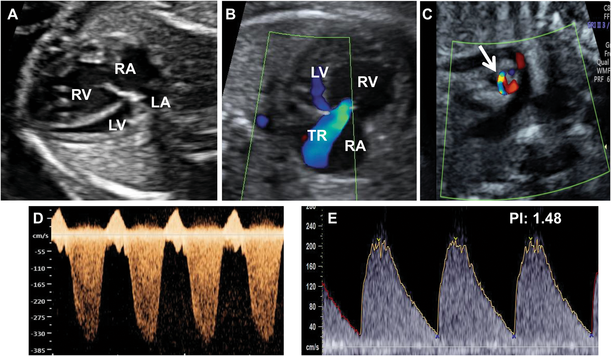 In Utero Idiopathic Ductal Constriction A Prenatal Manifestation Of Alagille And Williams Syndrome Arteriopathy Journal Of Perinatology