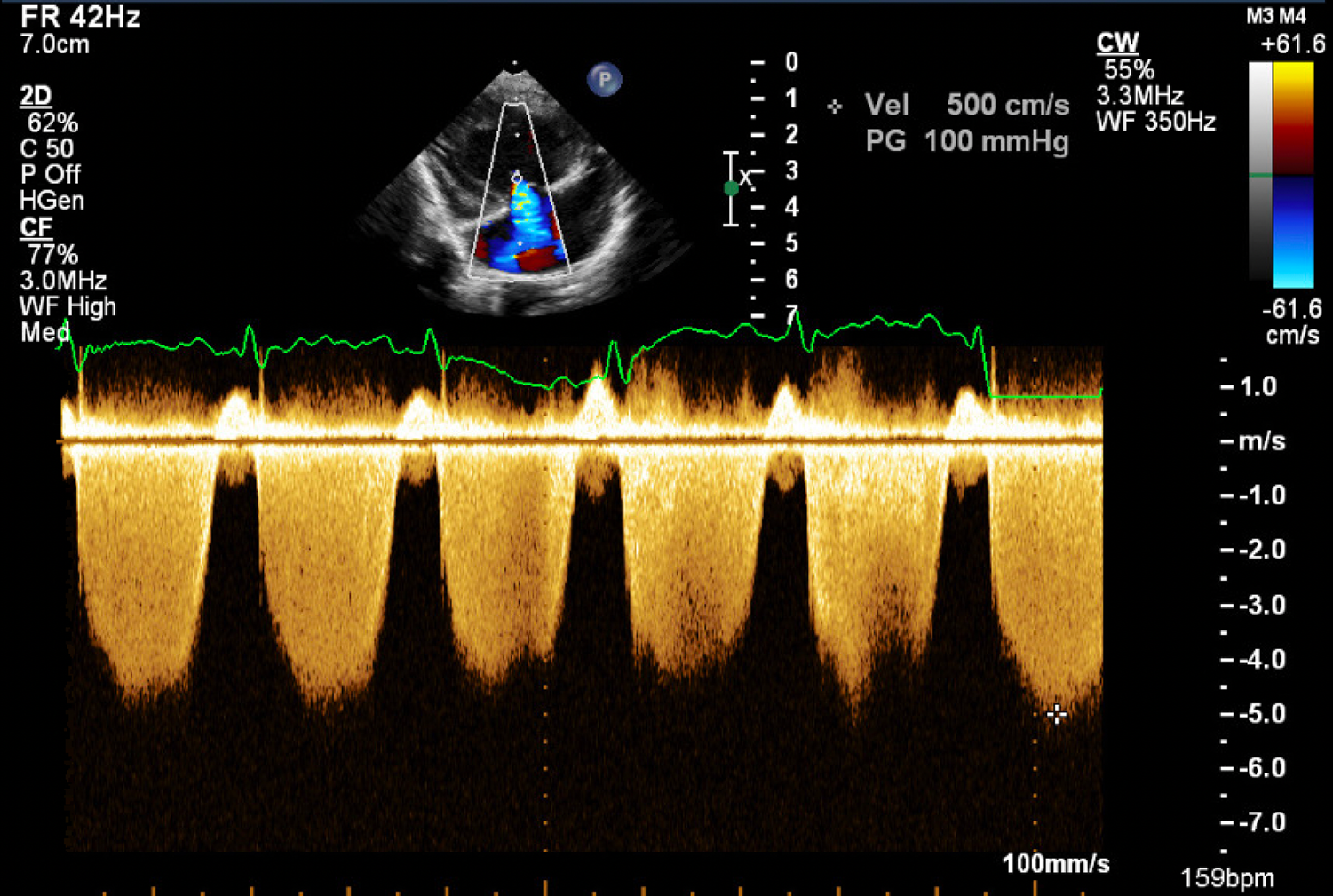 Echocardiography online normal values tables