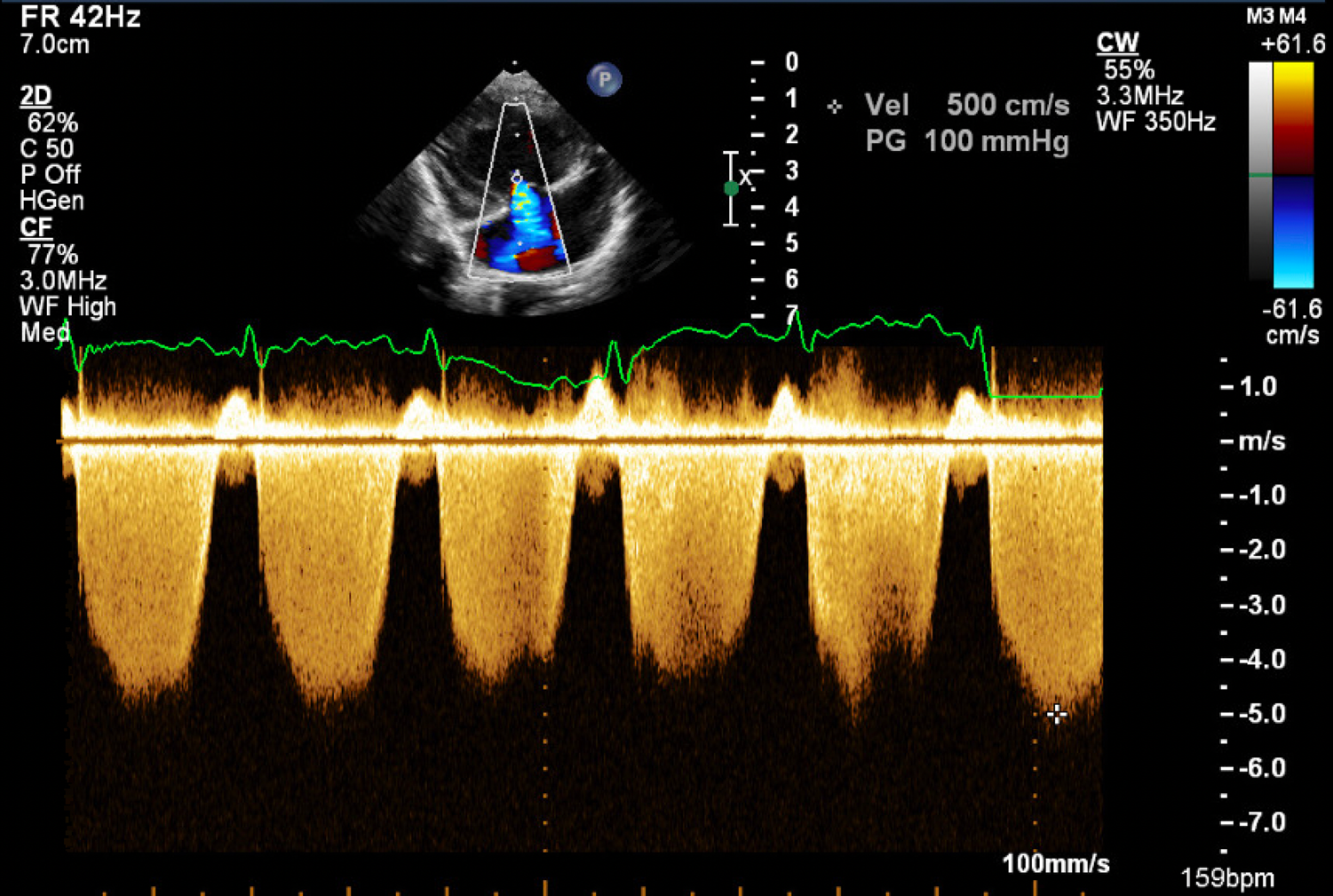 Role of strain echocardiography in patients with hypertension, Clinical  Hypertension