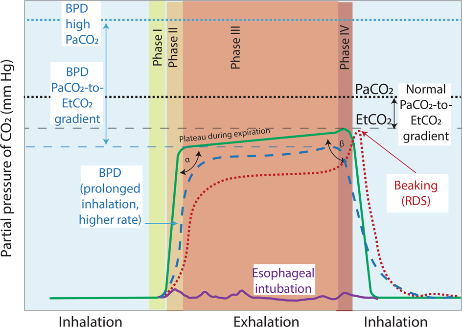 Non-invasive carbon dioxide monitoring in neonates: methods, benefits, and  pitfalls | Journal of Perinatology