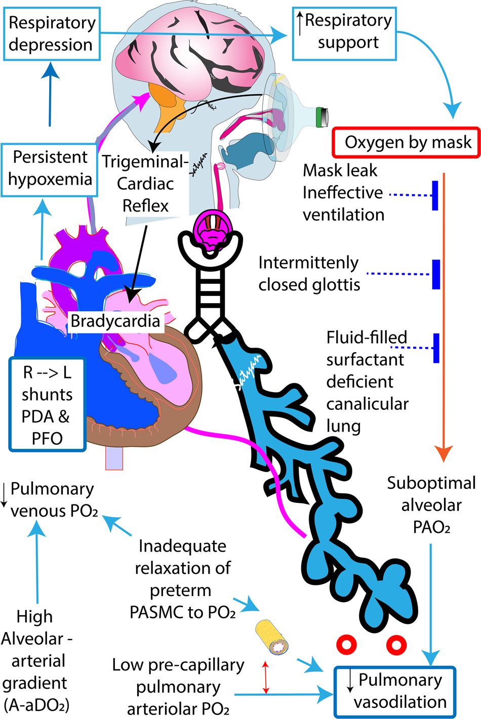 Hemodynamic consequences of respiratory interventions in preterm infants |  Journal of Perinatology