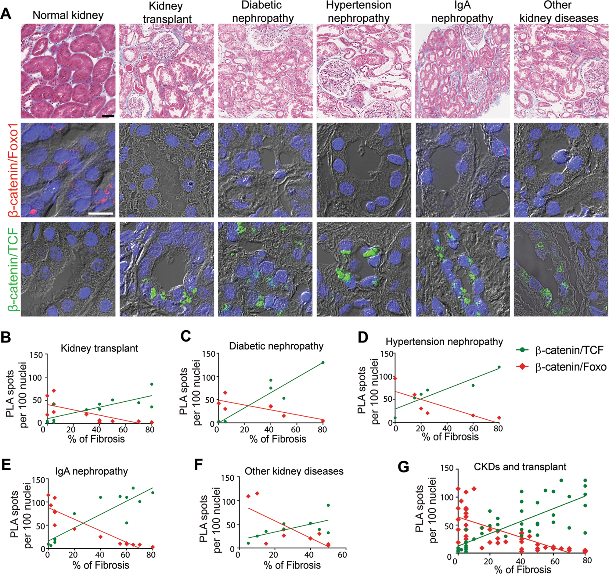 Promotion Of B Catenin Foxo1 Signaling Ameliorates Renal Interstitial Fibrosis Laboratory Investigation