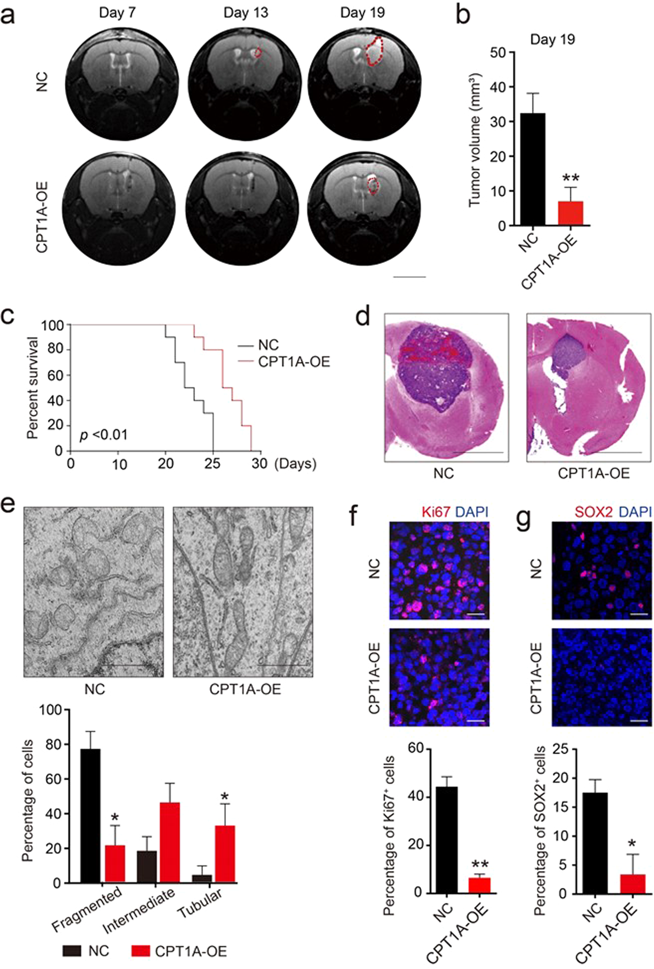Fig. 6: Overexpression of CPT1A inhibits the growth of GSC-derived xenografts and prolongs survival in tumor-bearing mice.