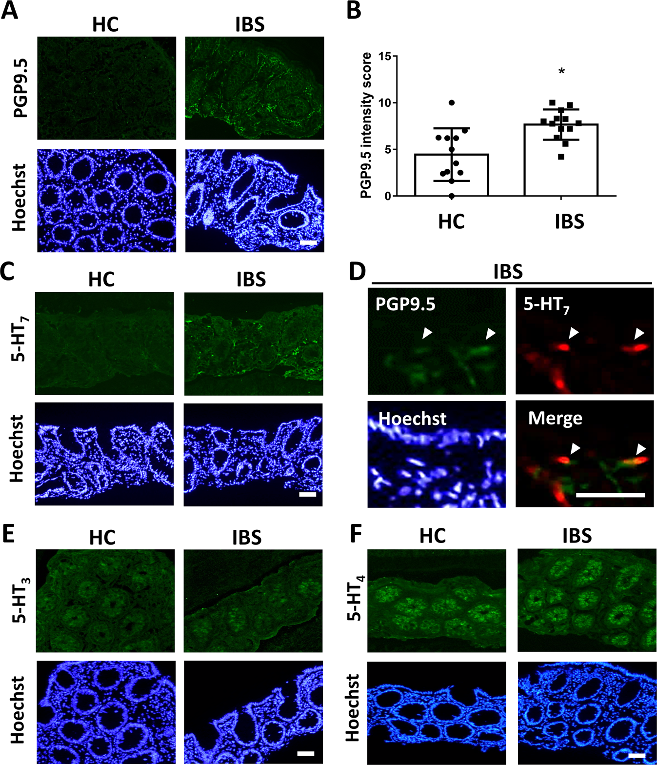 Study links back pain to a subtype of cells in spinal 'shock absorbers