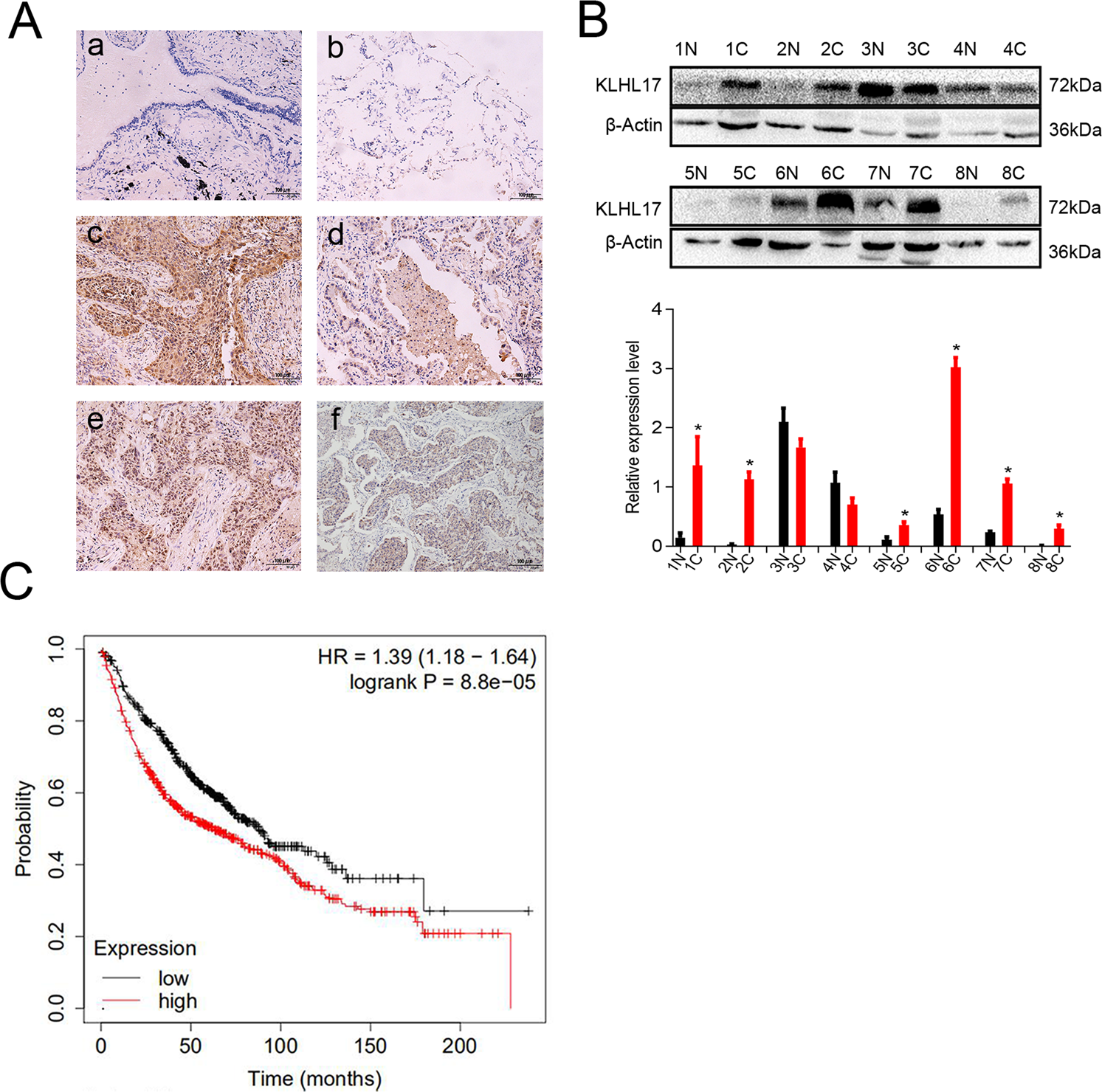 Fig. 2: KLHL17 is associated with poor prognosis of patients with non-small cell lung cancer.