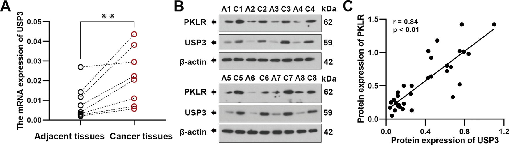 Fig. 1: USP3 is aberrantly expressed in gallbladder carcinoma (GBC) samples.