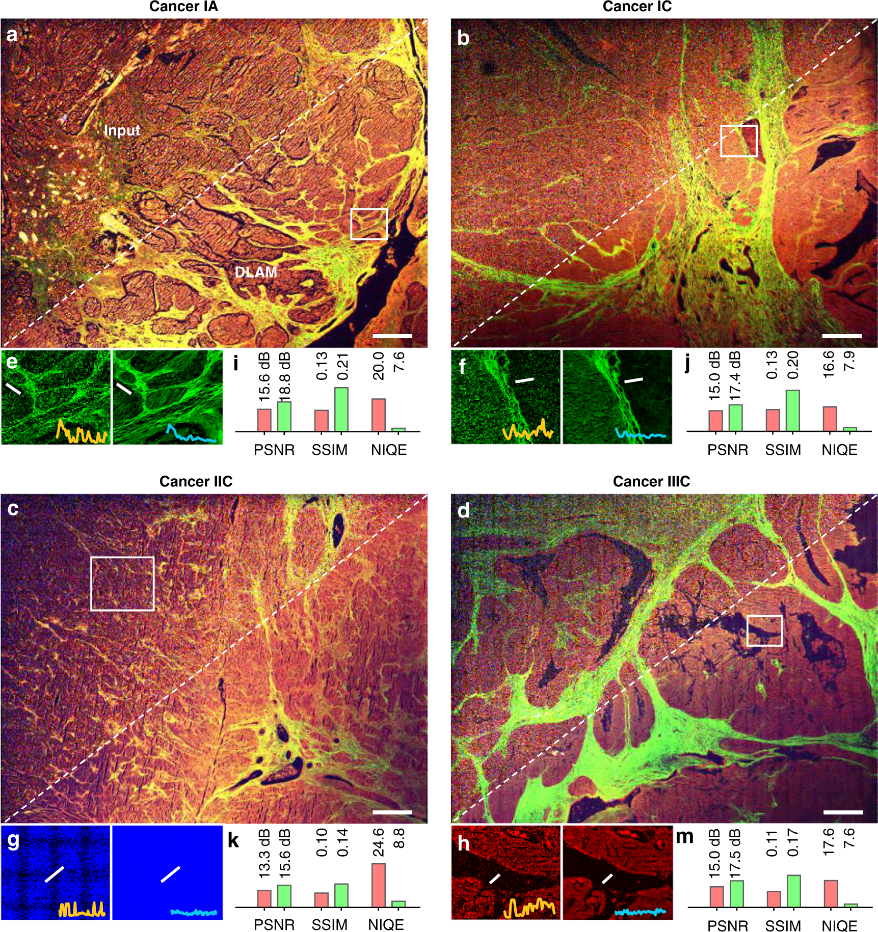Fig. 3: Label-free multimodal nonlinear images of human ovarian carcinomas.