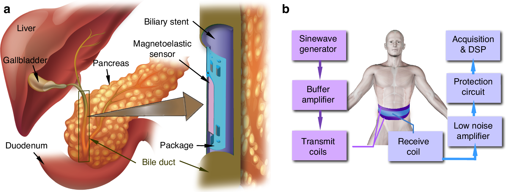 がん管理: ステントセンサーが胆管の閉塞を警告できる(Cancer management: Stent sensor can warn of blockages in the bile duct)