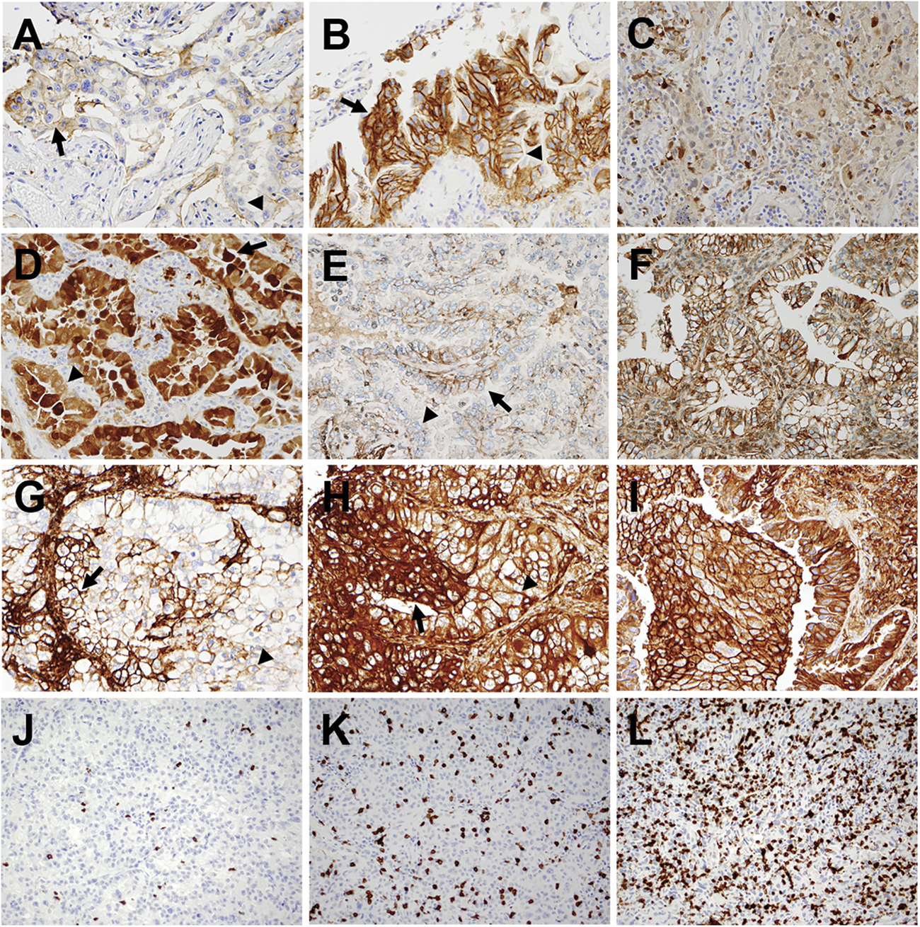 Diffeial Expression Of Pd L1 And Ido1 In Ociation With The Diffeial Expression Of Pd L1 And Ido1 In Ociation With The Immune Microenvironment Resected Lung Adenocarcinomas Modern Pathology