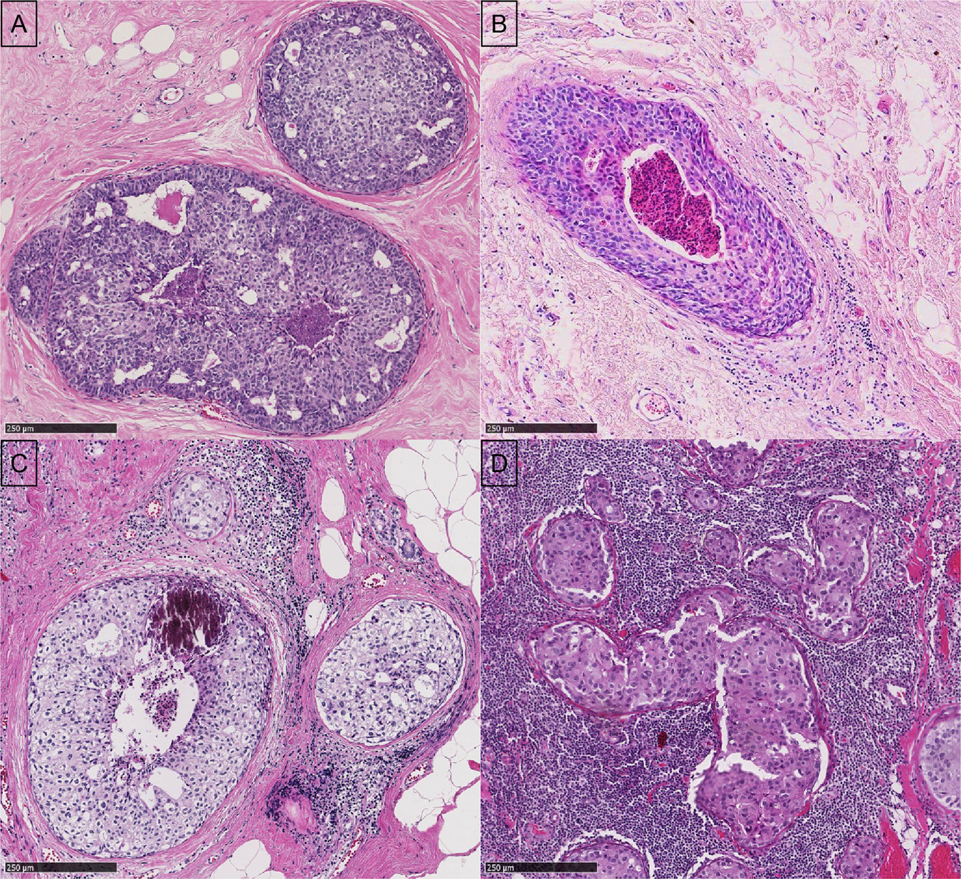 Ductal carcinoma in situ of the breast: immune cell composition according  to subtype | Modern Pathology