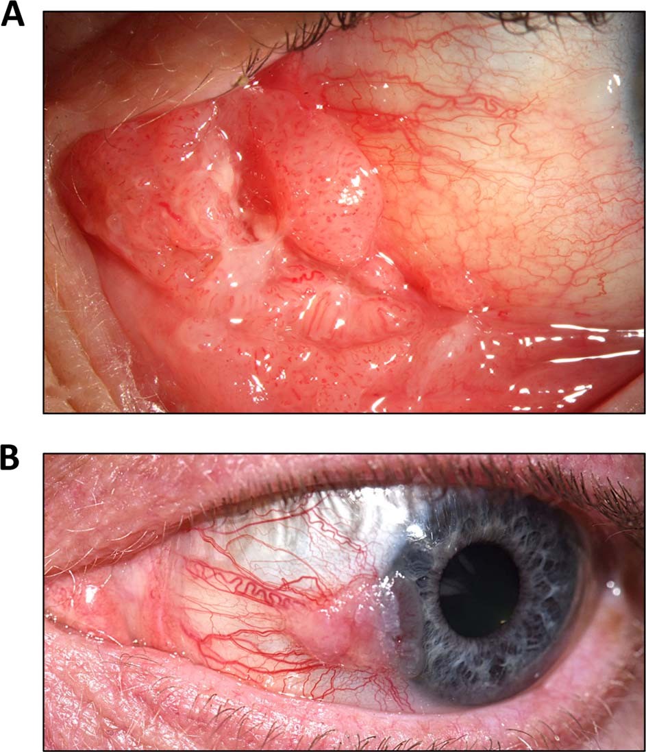 conjunctival papilloma treatment