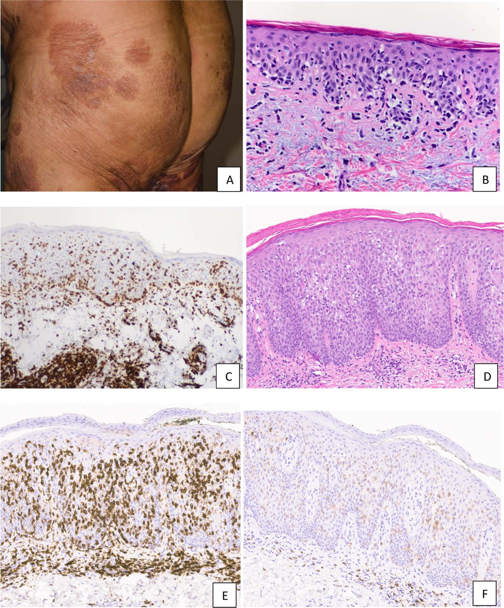 Diagnosis of T-cell lymphoid proliferations of the skin: putting all the  pieces together | Modern Pathology