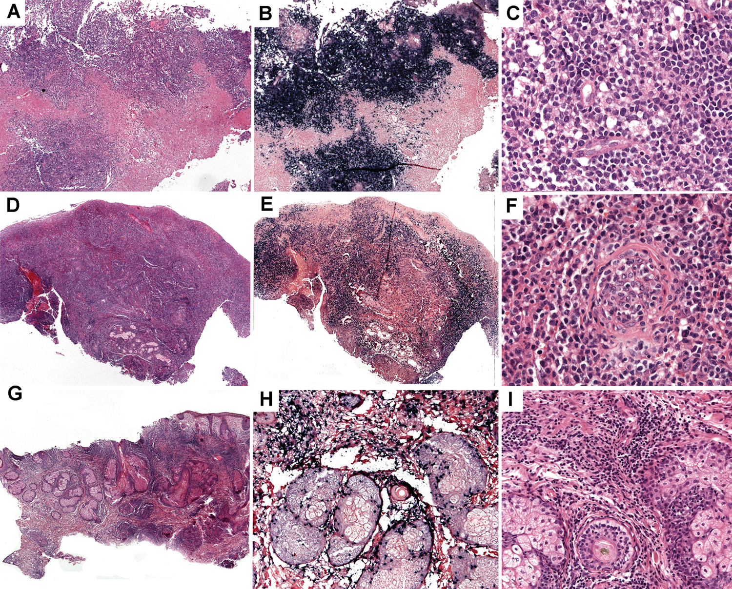 Mutational profile and EBV strains of extranodal NK/T-cell lymphoma, nasal  type in Latin America | Modern Pathology