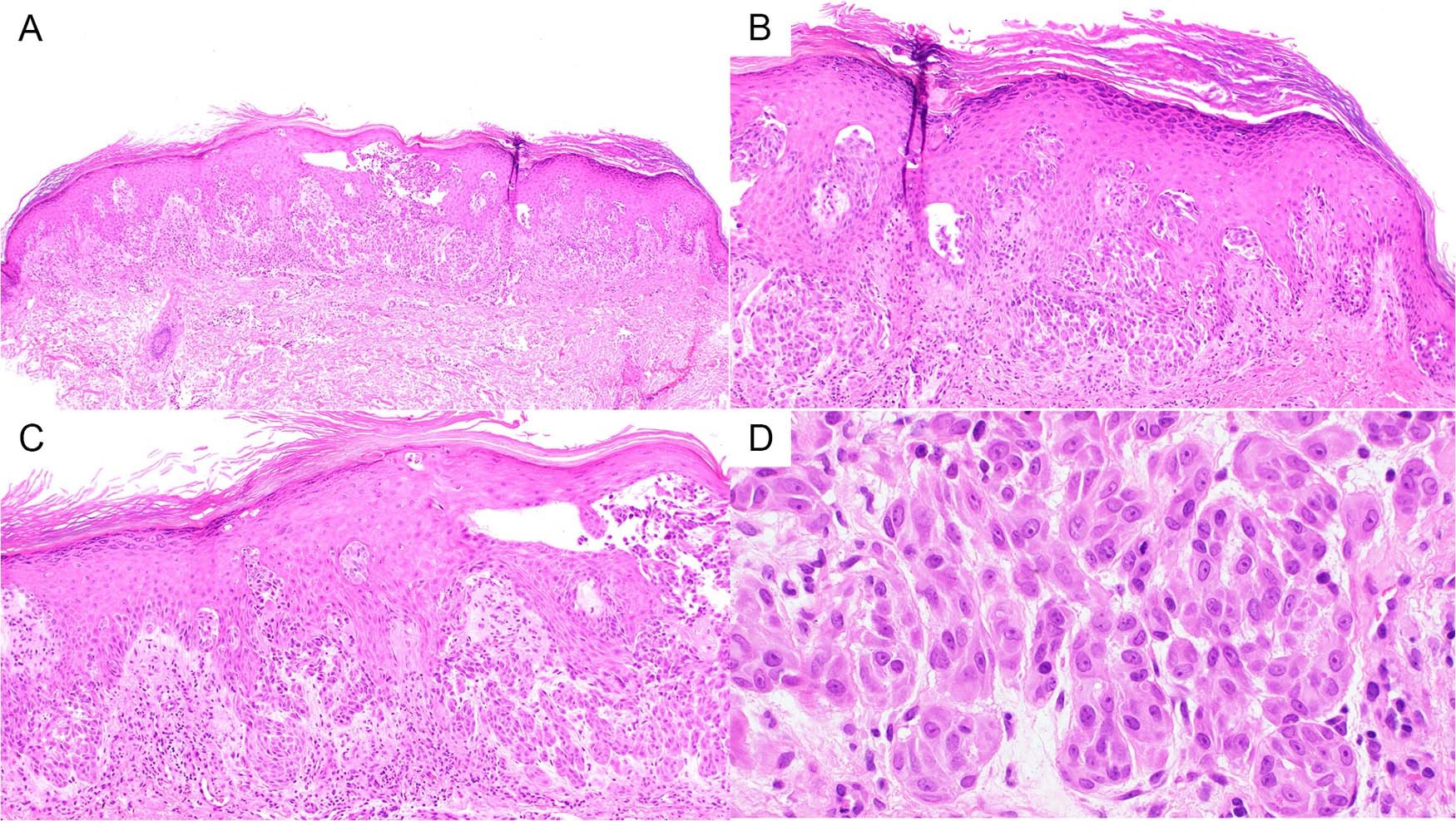 Fig. 2: Hematoxylin and Eosin staining on Case 2.