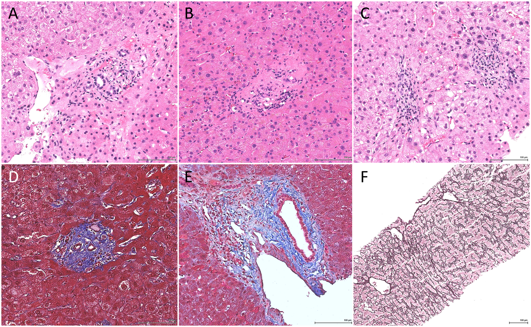 Fig. 1: Histologic features useful in the diagnosis of obliterative portal venopathy.