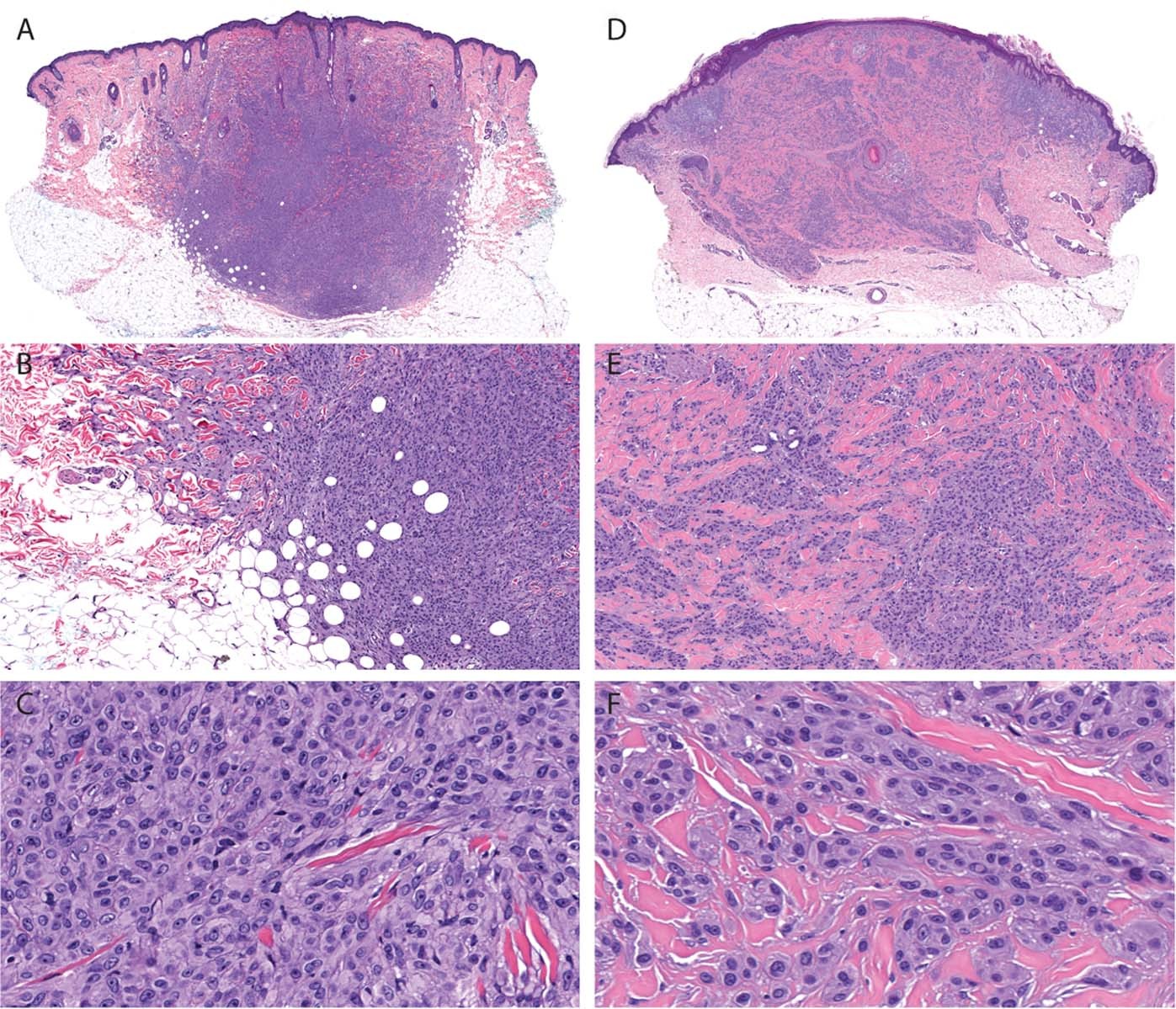 Fig. 5: Architectural and cytologic features of melanocytic tumors with MYH9-NTRK3 fusion.