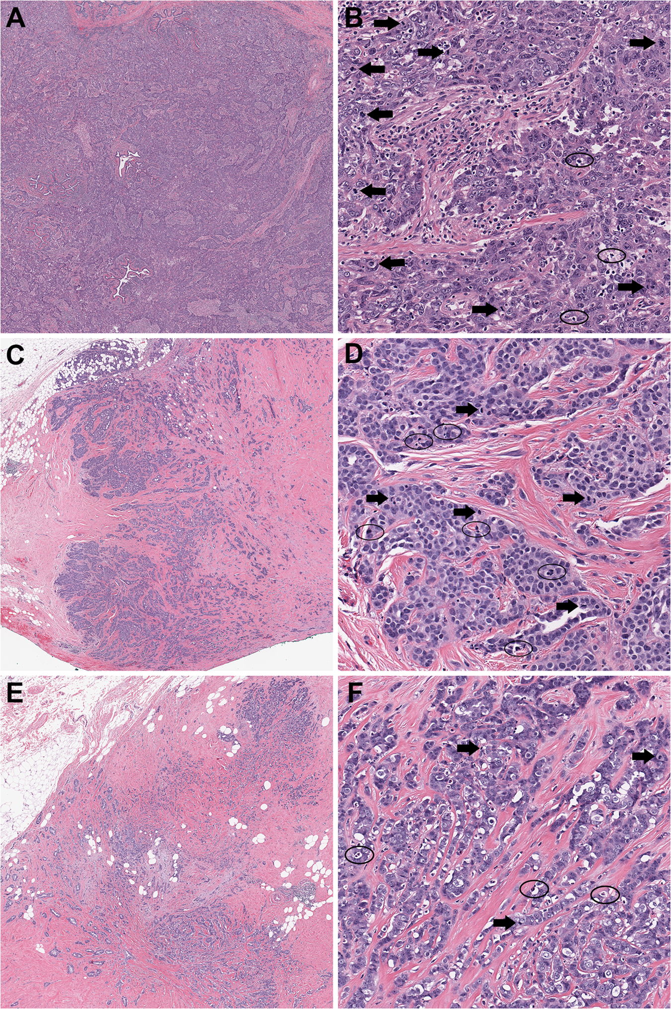 Histologic Grading Of Breast Carcinoma A Multi Institution Study Of Interobserver Variation Using Virtual Microscopy Modern Pathology