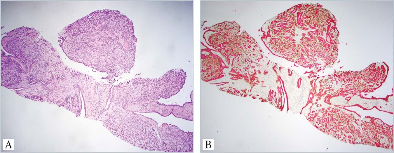 intraductal papilloma malignant potential papilom deteriorat