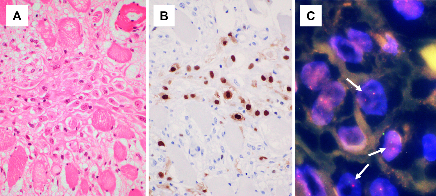 Fig. 5: A case of proliferative myositis (case 5).