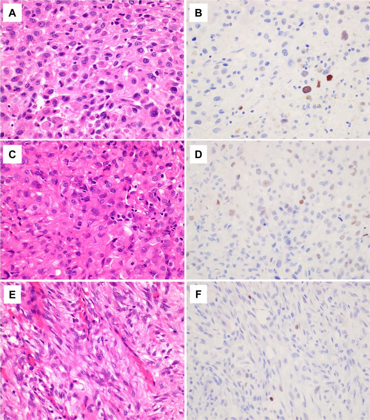 Fig. 8: c-FOS immunohistochemistry in histological mimics of proliferative fasciitis/myositis.