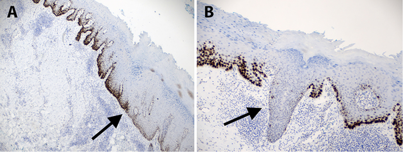 Fig. 5: Helpful clues in p53 interpretation of vulvar in situ squamous cell carcinoma (dVIN).
