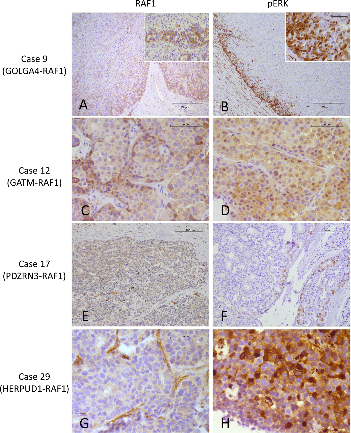 Fig. 3: Patterns of RAF1 and pERK immunostaining in acinar cell carcinomas.