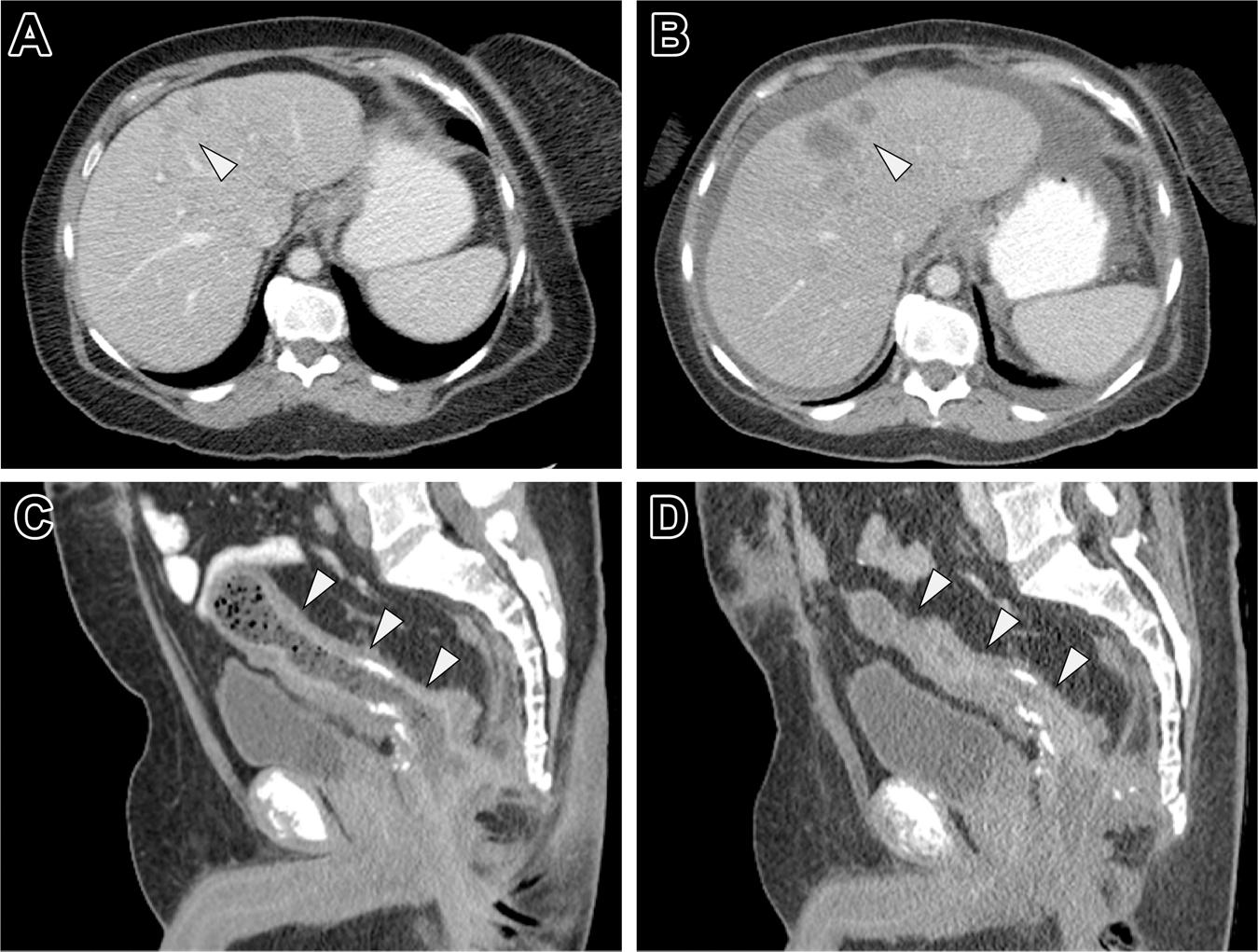Fig. 2: An EGFR inhibitor-based treatment regimen was characterized by disease progression in patients with KRAS-amplified mCRC.
