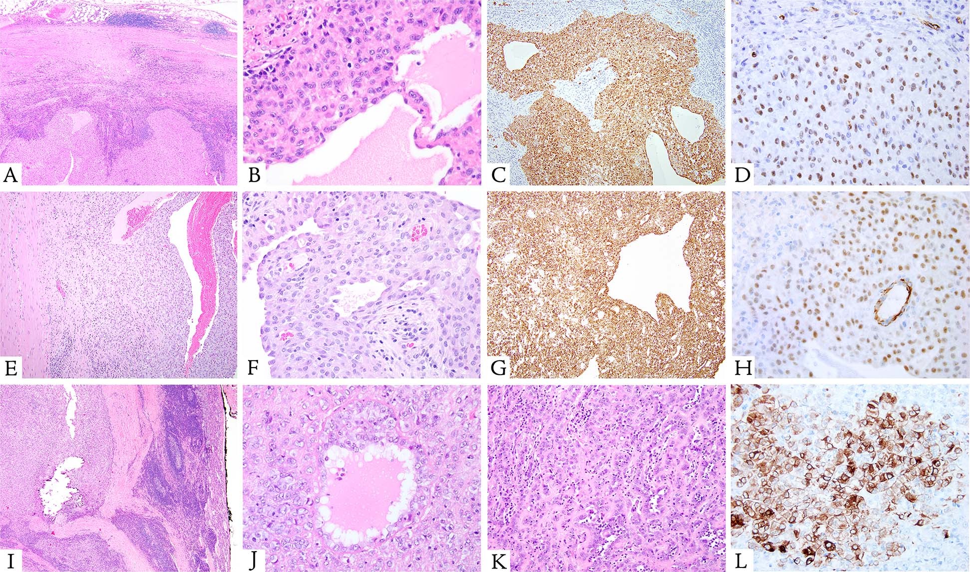 Fig. 1: Microscopic features of peritoneal lesions with EWSR1–CREM fusion and co-expression of cytokeratin and WT1.