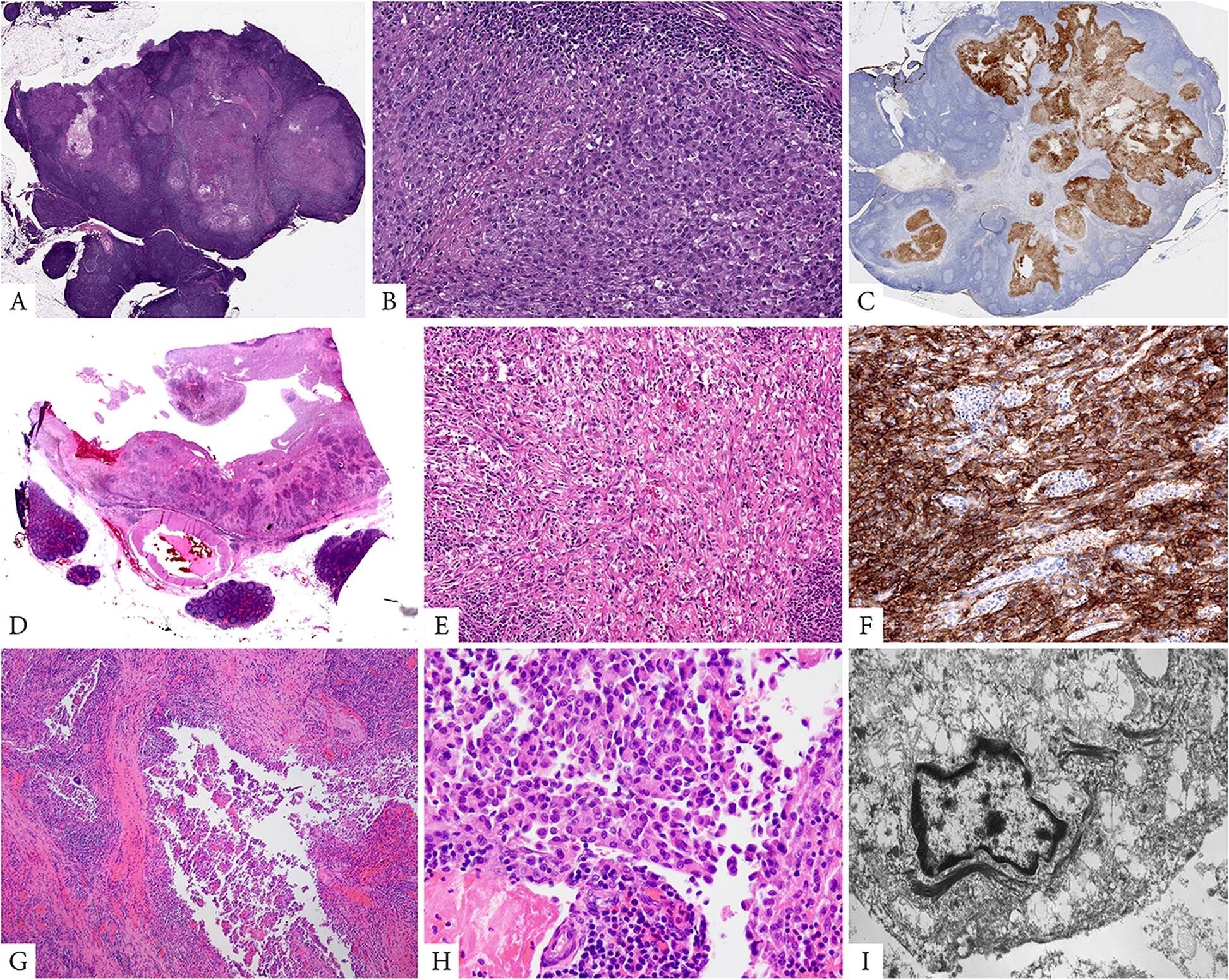 Fig. 3: Pathologic findings of peritoneal tumors harboring alternative fusions (FUS–CREM and EWSR1–ATF1 fusions).