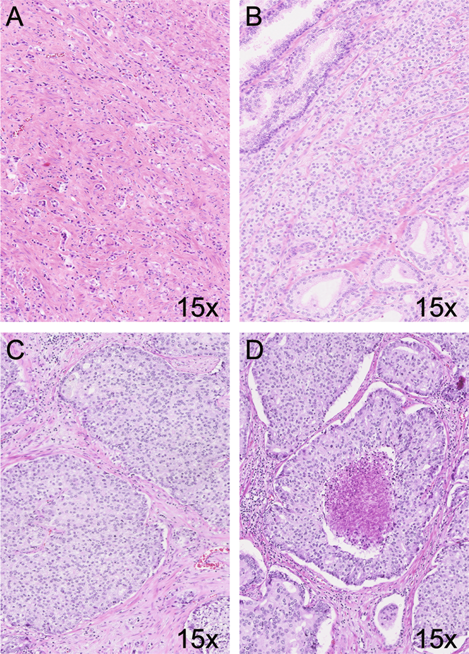 adenocarcinoma prostate gleason 6 33)