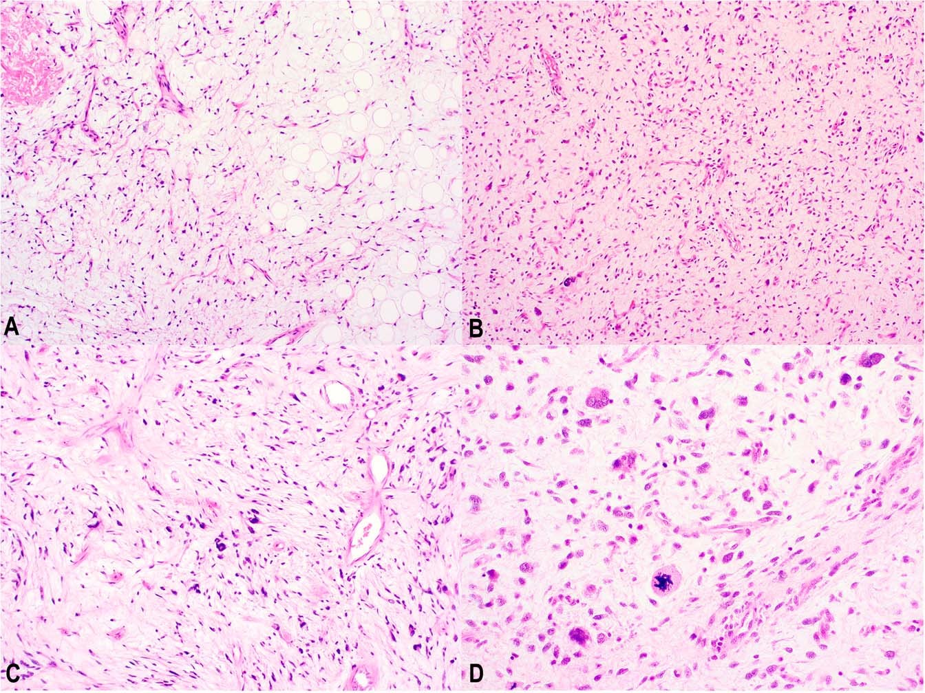 Myxoid pleomorphic liposarcoma—a clinicopathologic, immunohistochemical,  molecular genetic and epigenetic study of 12 cases, suggesting a possible  relationship with conventional pleomorphic liposarcoma | Modern Pathology
