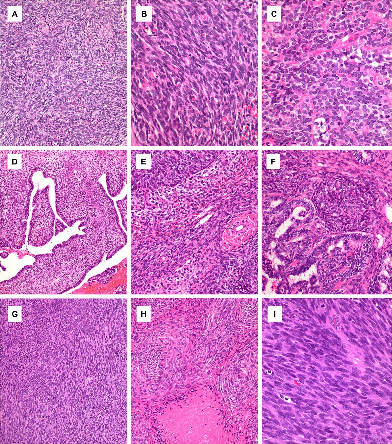 Fig. 1: Morphological findings of synovial sarcomas with EWSR1-SSX1 fusions (cases 1–3).