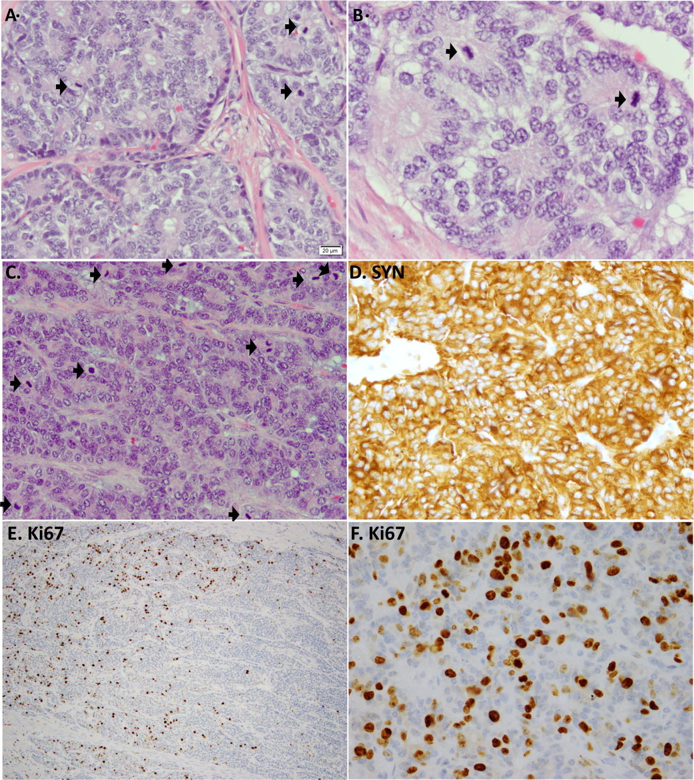 Lung Neuroendocrine Neoplasms Recent Progress And Persistent Challenges Modern Pathology
