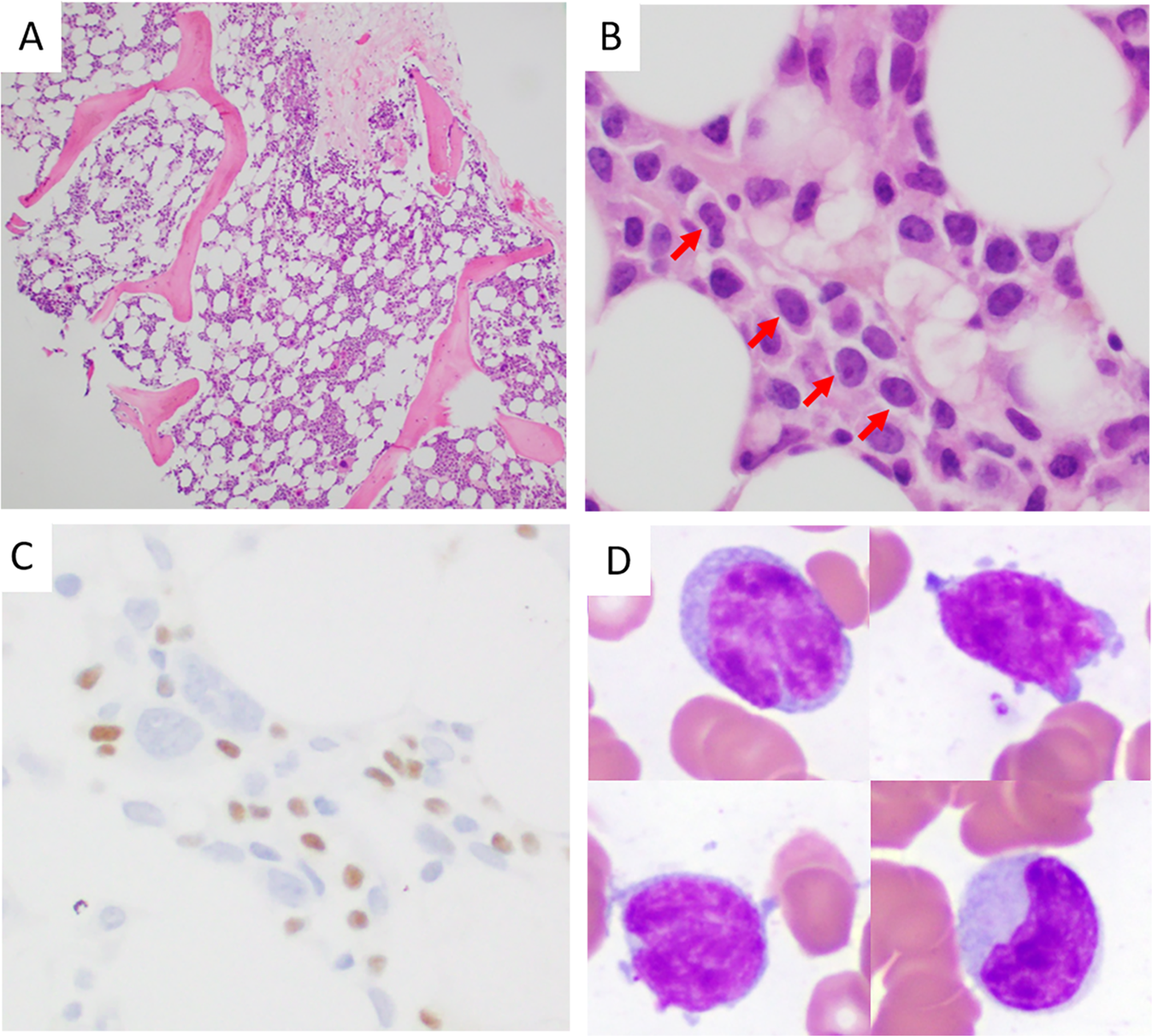 Fig. 2: A small cell ALK + ALCL case involving bone marrow and peripheral blood.