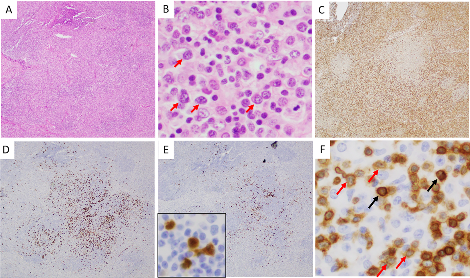 Fig. 3: An ALK + ALCL case with a lymphohistiocytic pattern.