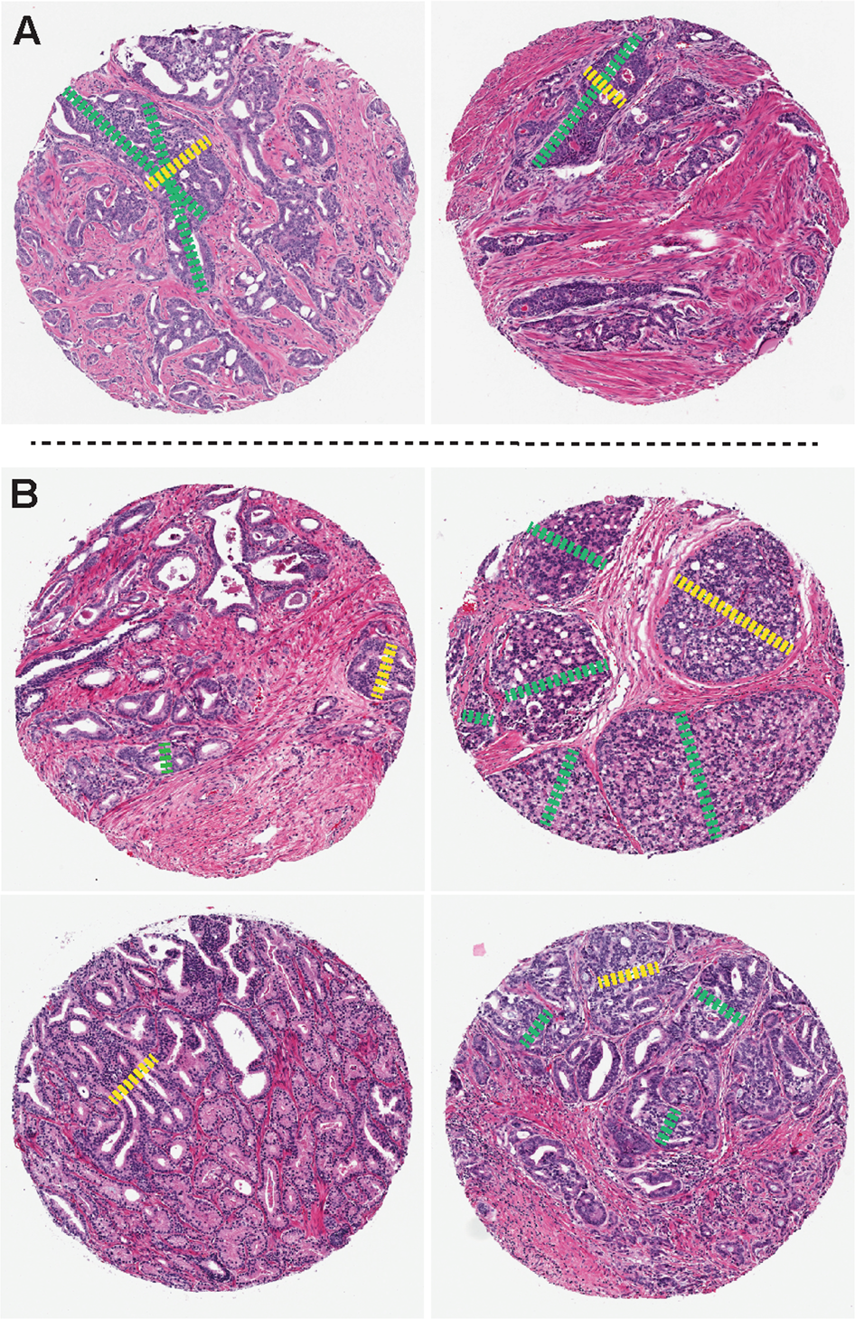 Analysis of separate training and validation radical prostatectomy cohorts  identifies 0.25 mm diameter as an optimal definition for “large” cribriform  prostatic adenocarcinoma | Modern Pathology