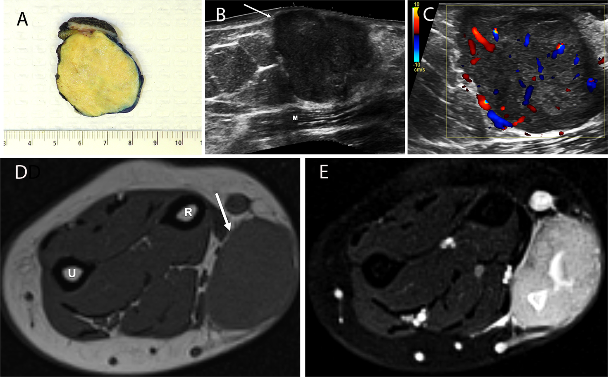 Xanthogranulomatous epithelial tumors and keratin-positive giant cell-rich  soft tissue tumors: two aspects of a single entity with frequent  HMGA2-NCOR2 fusions | Modern Pathology, image size:1974x1225