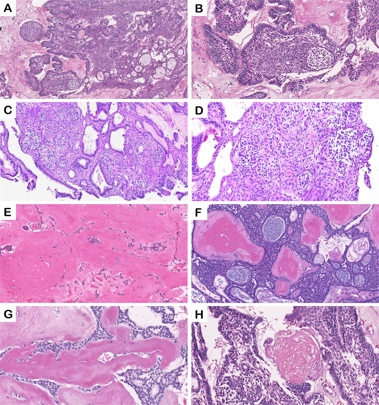 Fig. 1: Representative images of histopathological features of the included adenoid ameloblastoma cases.