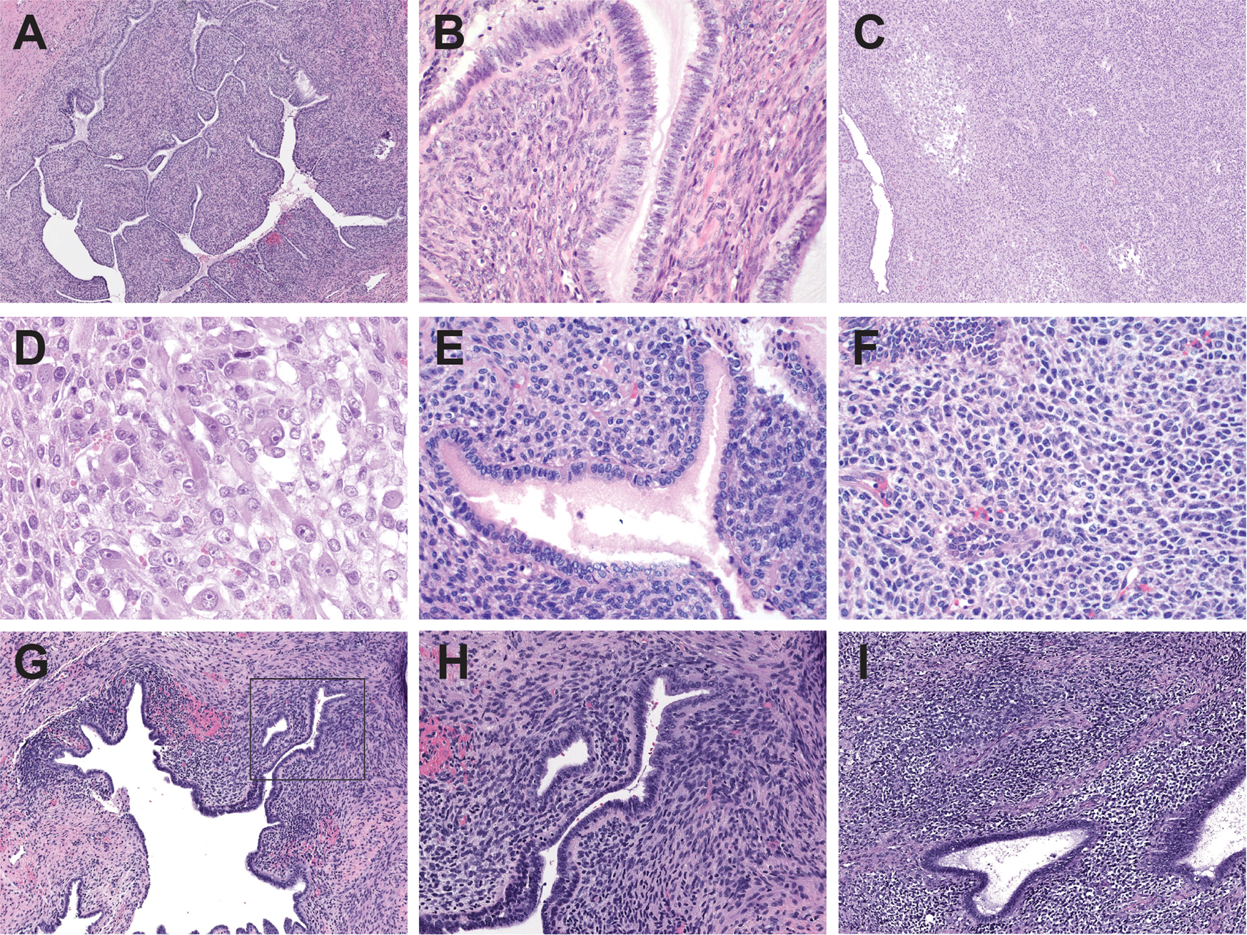 Fig. 1: Histomorphologic spectrum of Mullerian adenosarcomas.