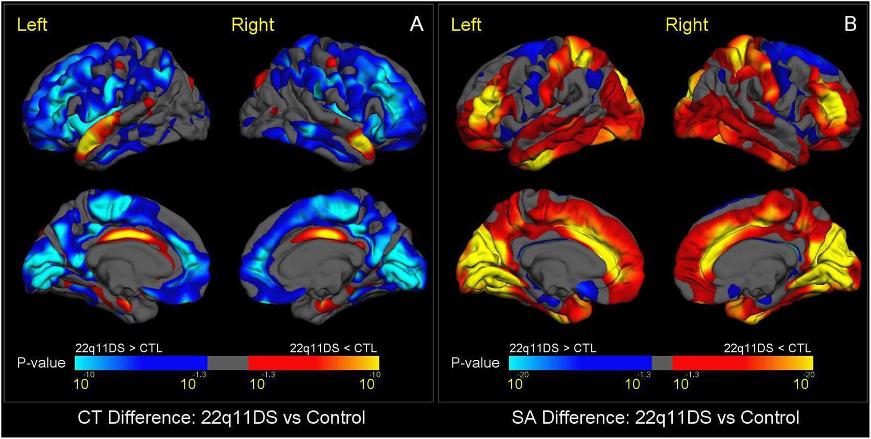 Large Scale Mapping Of Cortical Alterations In 22q112 Deletion