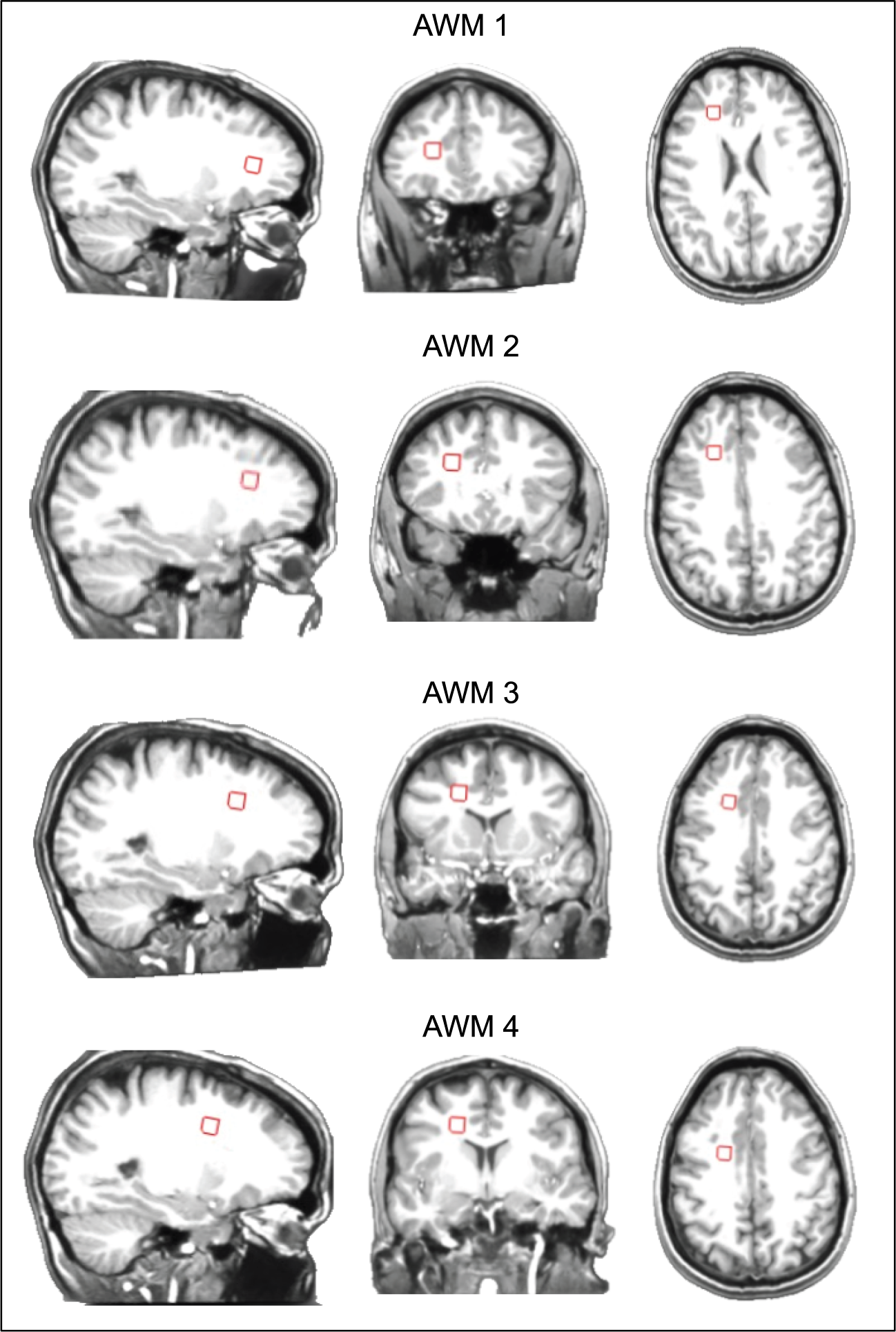 Altered neurochemistry in the anterior white matter of bipolar children and  adolescents: a multivoxel 1H MRS study | Molecular Psychiatry